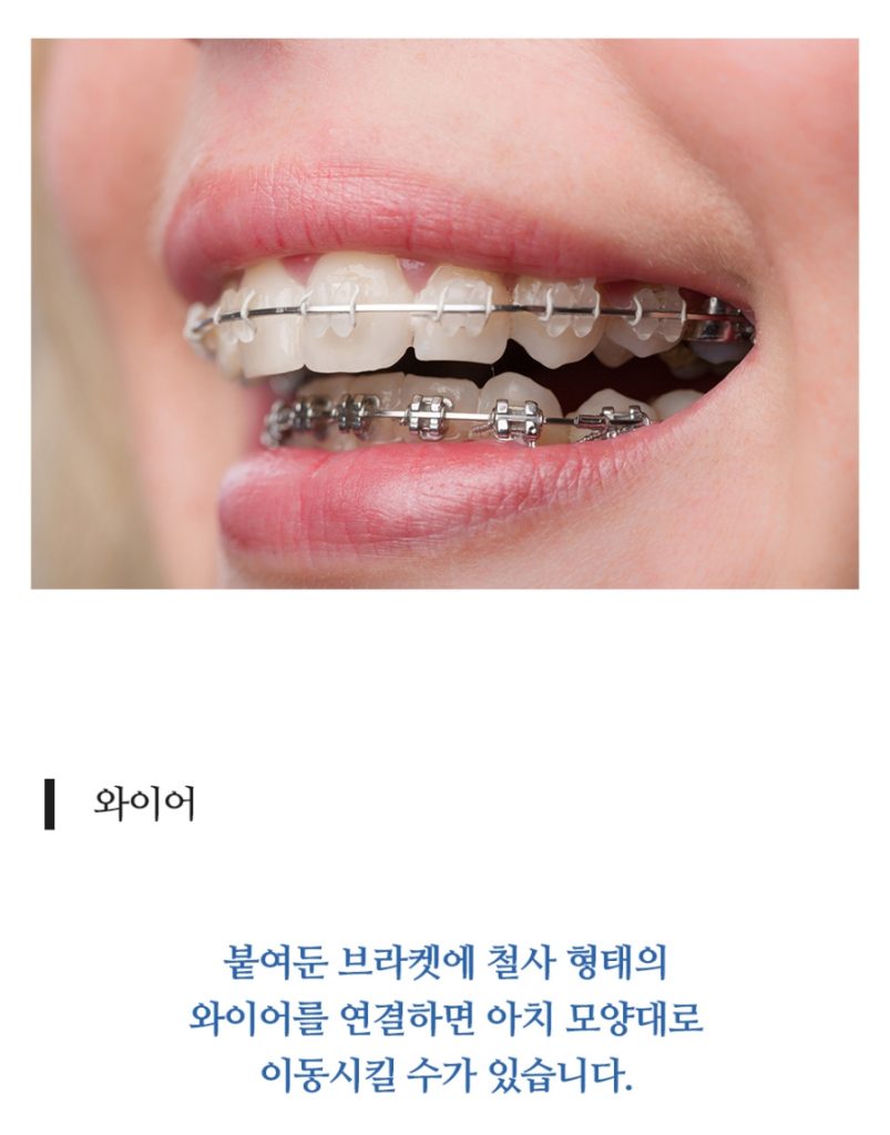 임플란트 복붙이미지 (15)