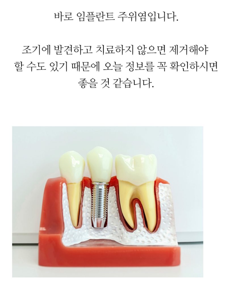 임플란트 복붙이미지 2 (13)