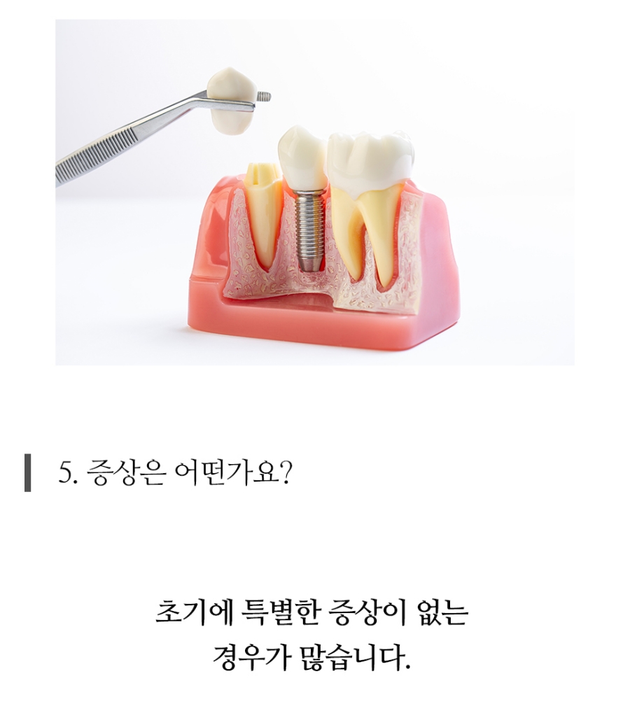 임플란트 복붙이미지 2 (17)