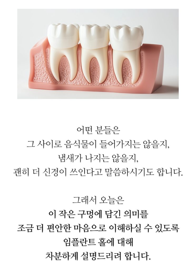 임플란트 복붙이미지 2 (2)