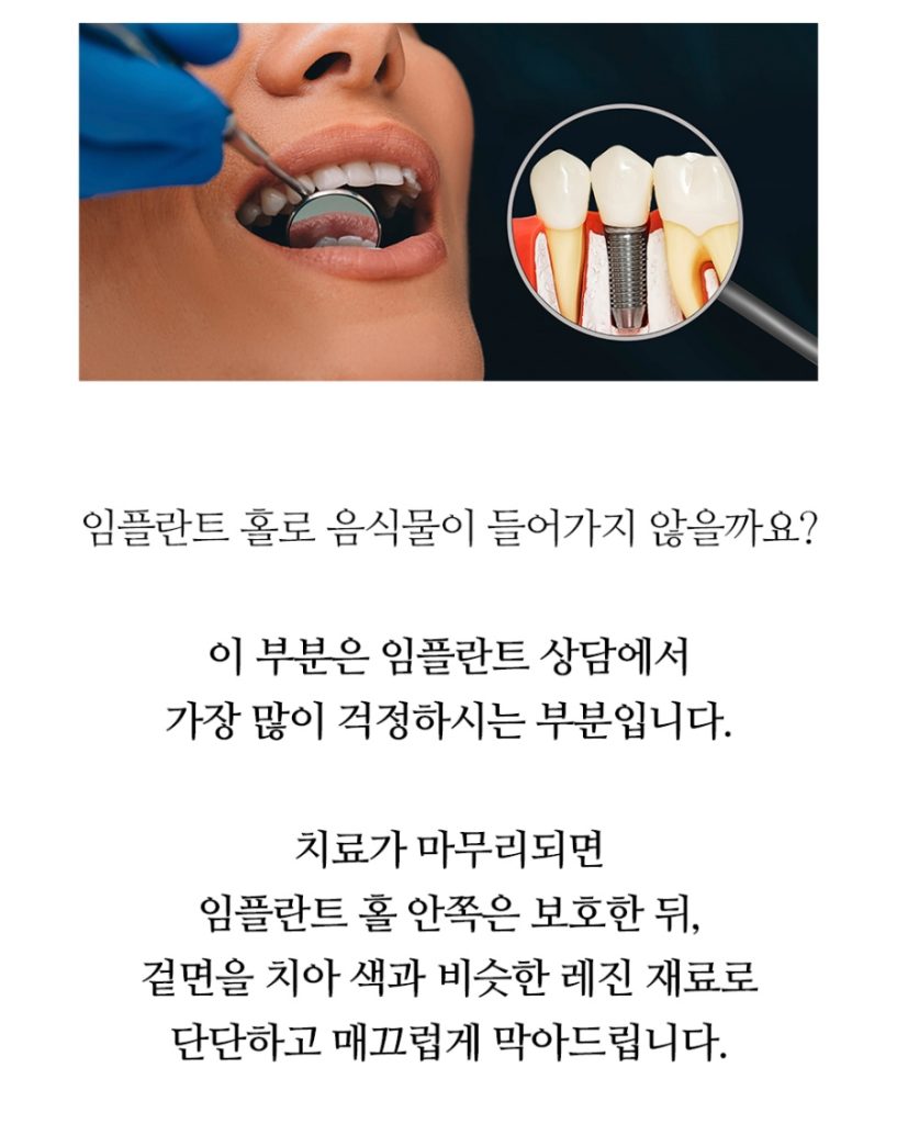 임플란트 복붙이미지 2 (8)