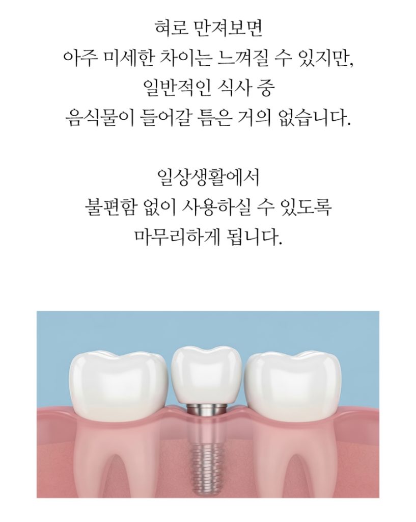 임플란트 복붙이미지 2 (9)
