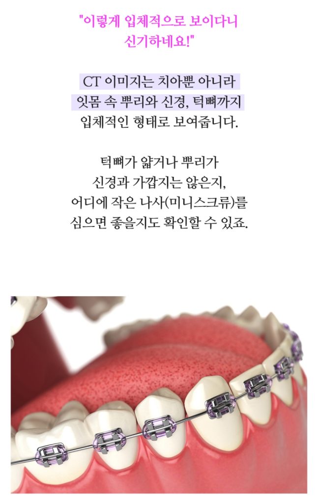 임플란트 복붙이미지 (7)