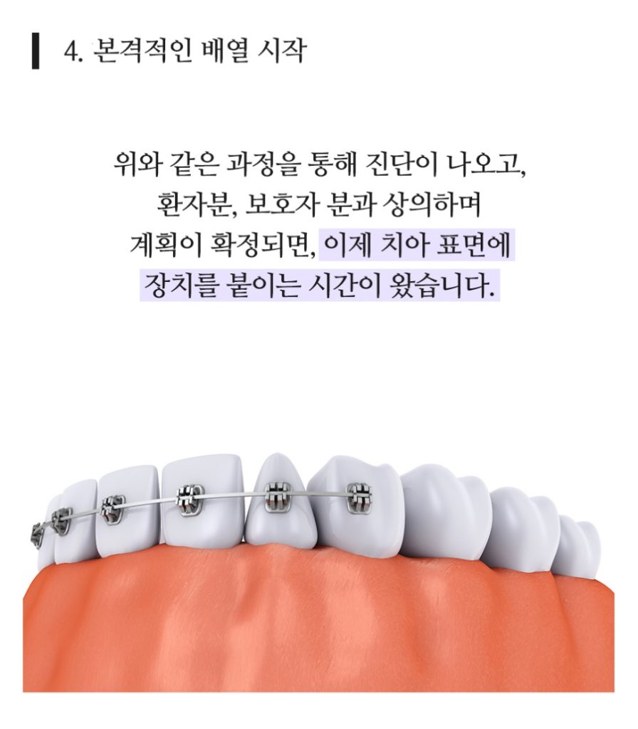 임플란트 복붙이미지 (9)
